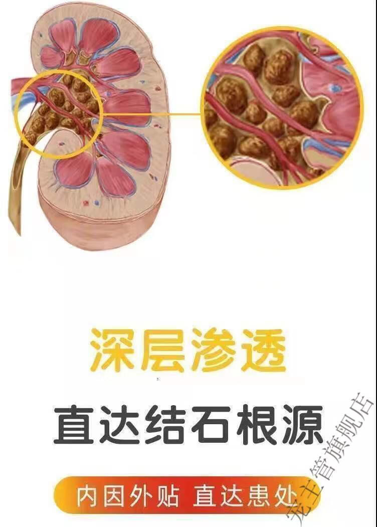 【肾绞痛】你需要知道的那些事